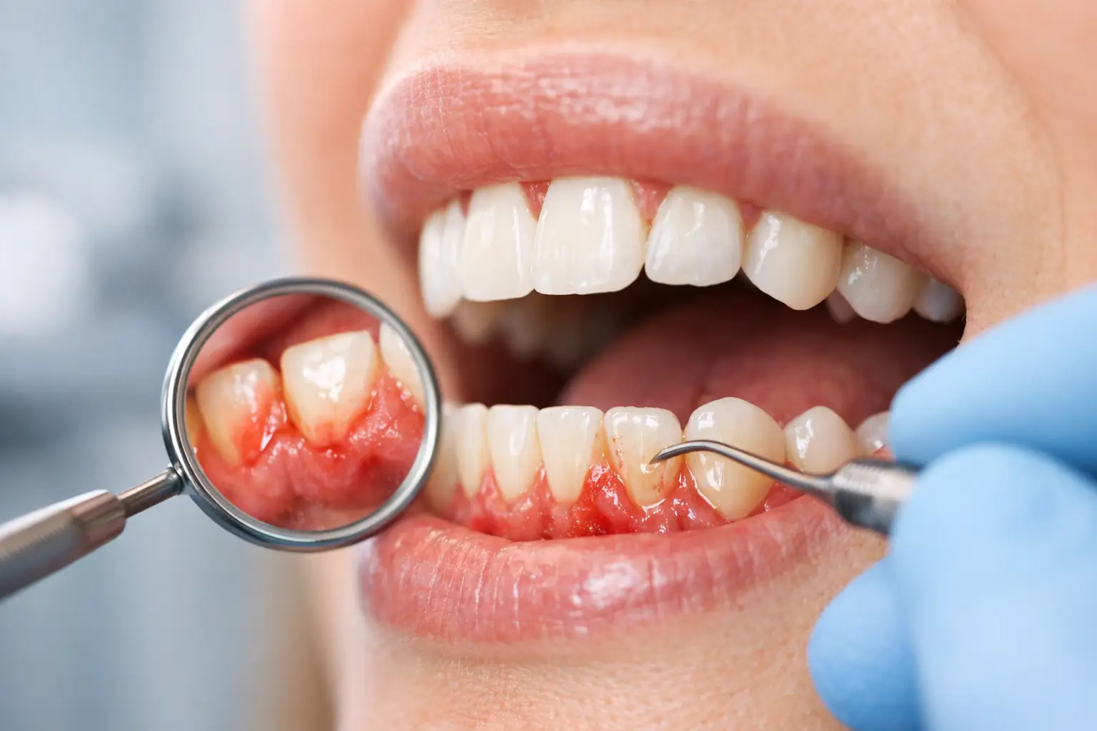 Early Signs of Gum Disease to Watch For